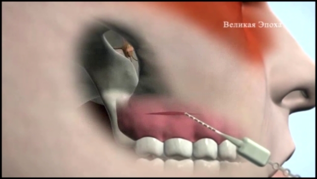 Видеоклип В США добровольцам установили имплантант от изнуряющей головной боли