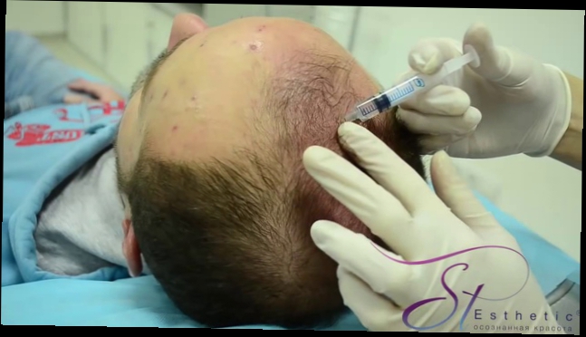 Видеоклип Лечение выпадения волос- мезороллер (методика). estet-portal.com