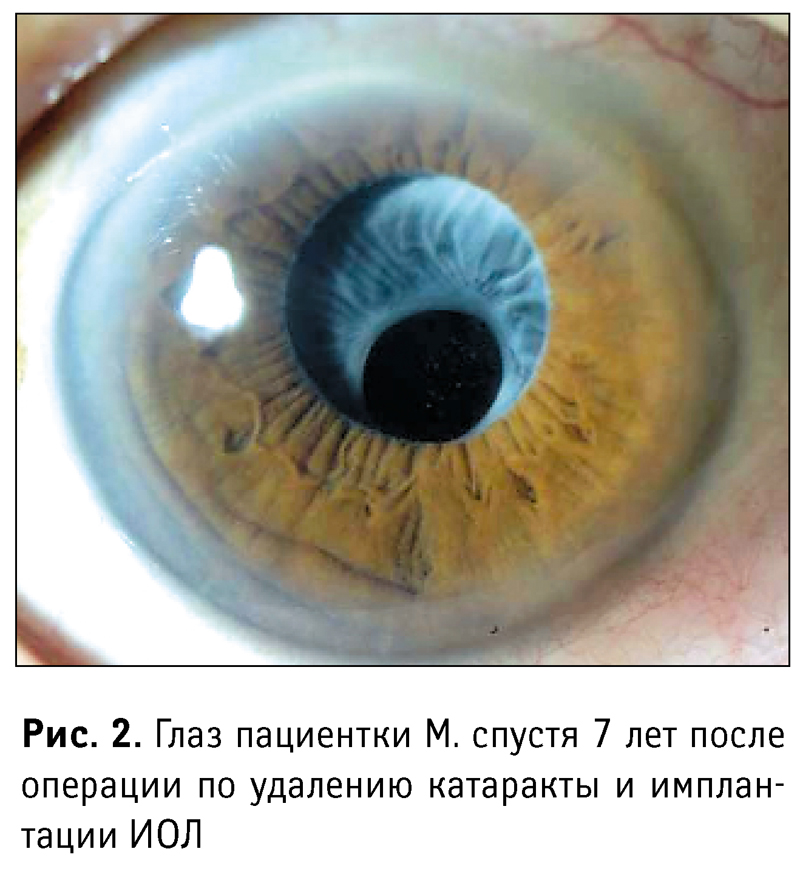 Глаза пациентки | Комнаты смерти 2